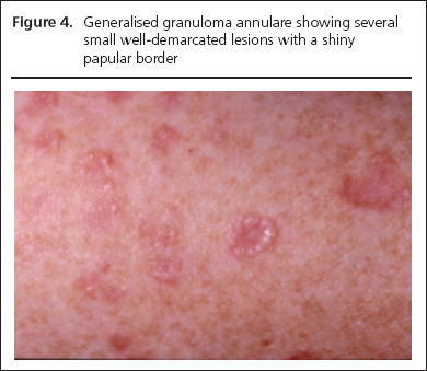 Necrobiosis lipoidica and granuloma annulare: Part 2- Granuloma ...